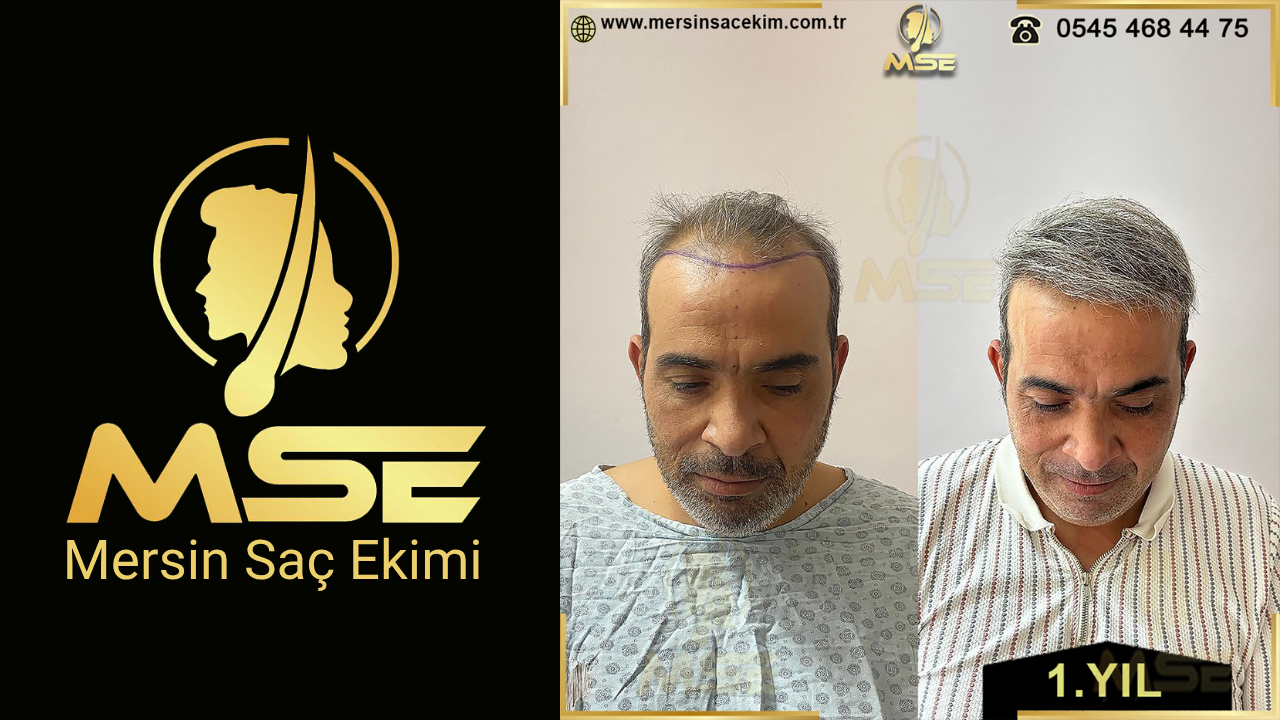 MERSİN SAÇ EKİMİ